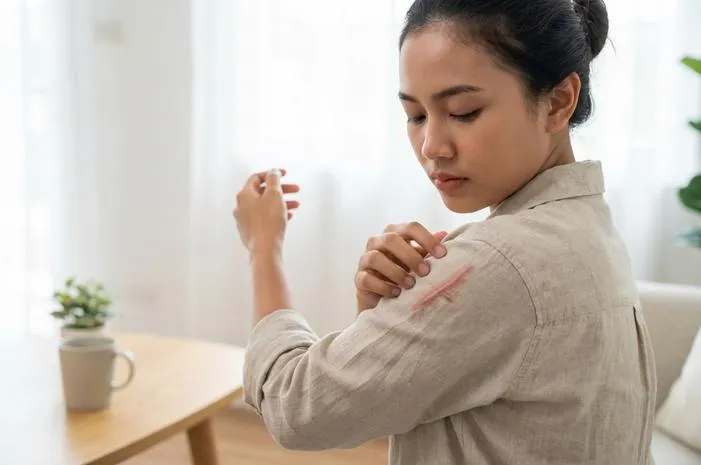 Keloid Gatal Mengganggu? Atasi dengan Cara Ini!