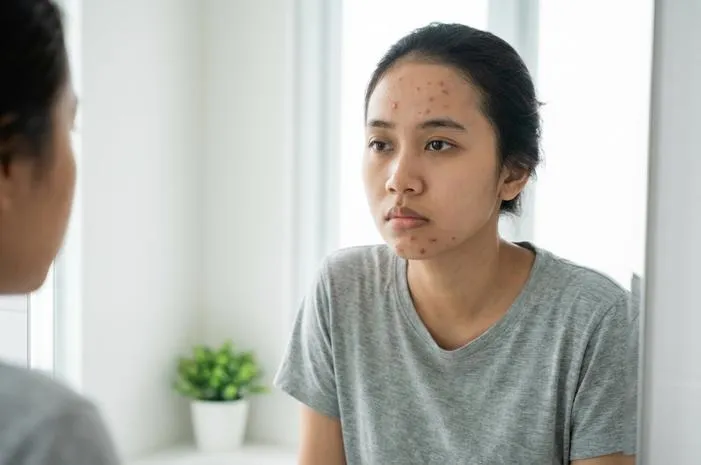 Ciri Jerawat Begadang: Kenali Tanda di Area T-Zone