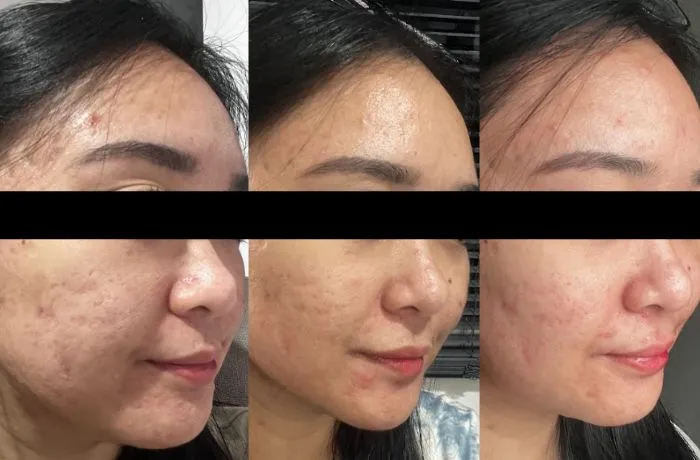 Perjalanan Pejuang Jerawat, Konsisten 14 Hari Melawan Jerawat Hormonal dengan Haloskin