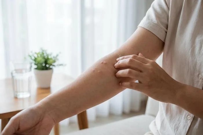 Atasi Bentol Bentol Kecil Gatal, Coba Cara Ini