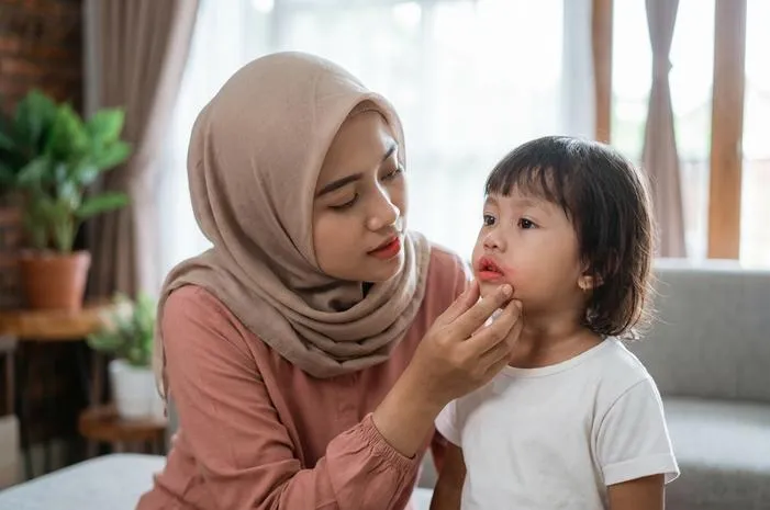 Bibir Merah pada Anak, Kapan Harus Khawatir?