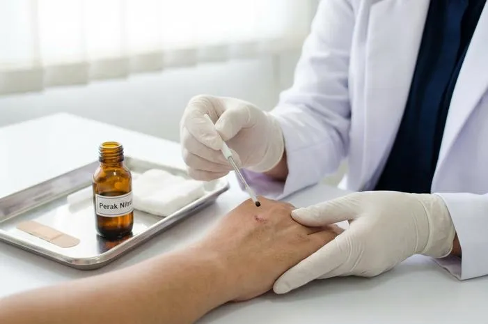 Perak Nitrat: Dari Noda Pemilu Hingga Obat, Waspadai!