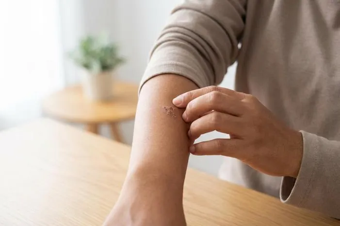 Krusta bukan Kusta! Pahami Perbedaan Koreng Luka