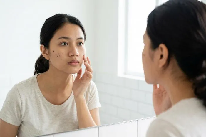 Atasi Jerawat Hitam di Pipi, Kulit Mulus Lagi!