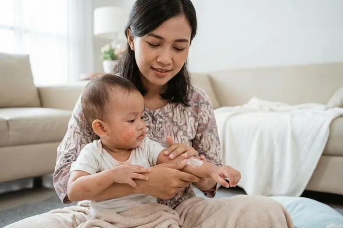 Kulit Gatal Bayi? Pahami dan Atasi Dermatitis Atopik
