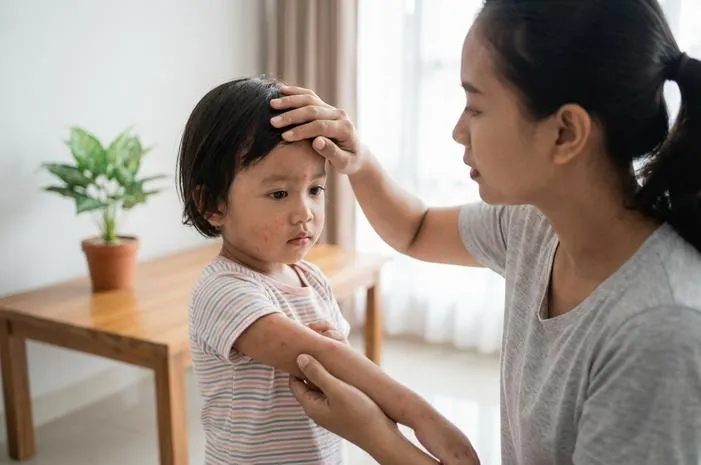 Penyakit Kerumut: Hilangkan Demam dan Ruam Merah Cepat