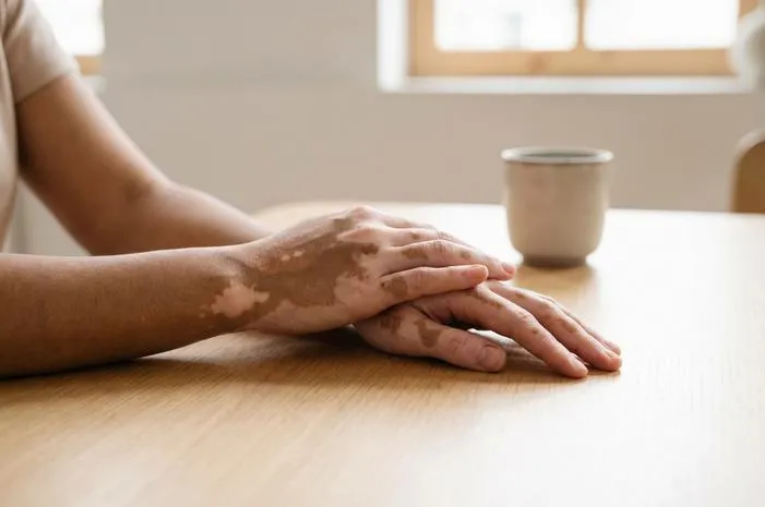 Yuk Kenali Vitiligo: Bercak Putih Kulit