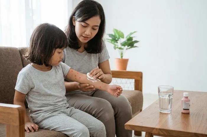 Redakan Gatal Chickenpox: Tips Perawatan Lengkap