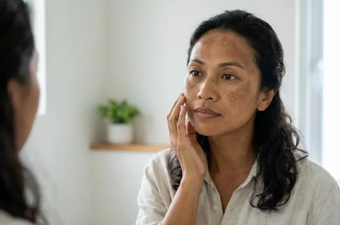 Mengerti Hiperpigmentasi Kulit: Penyebab dan Solusi