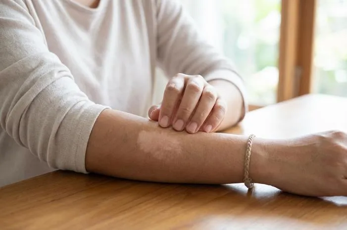 Berapa Lama Kulit Belang Kembali Normal? Cari Tahu Yuk!