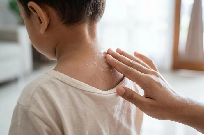 Miliaria Kristalina: Biang Keringat Bayi Ringan, Mudah Atasi