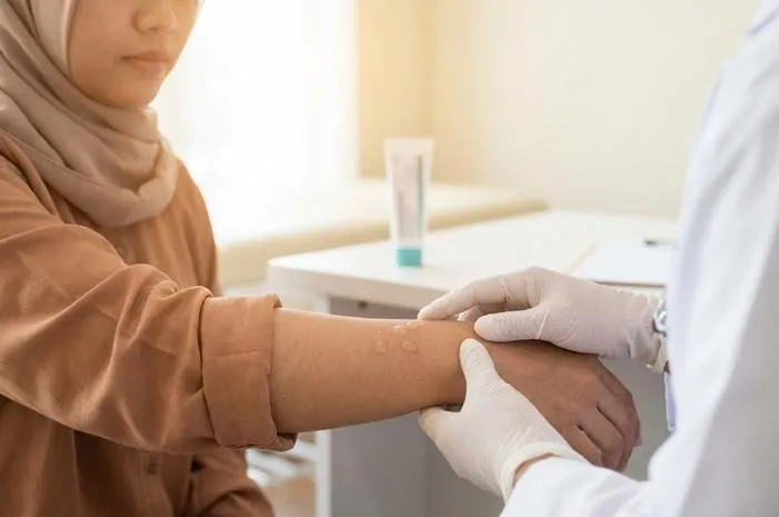 Penyakit Kulit Seperti Melepuh dan Berair? Ini Solusinya!