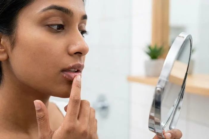 Jangan Panik! Atasi Bibir Bintik Berair dengan Ini