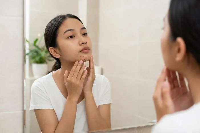 Ciri-Ciri Jerawat PCOS: Muncul di Rahang dan Susah Hilang