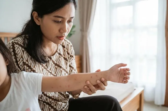 Ketahui Jenis Jenis Cacar: dari Air, Api hingga Monyet