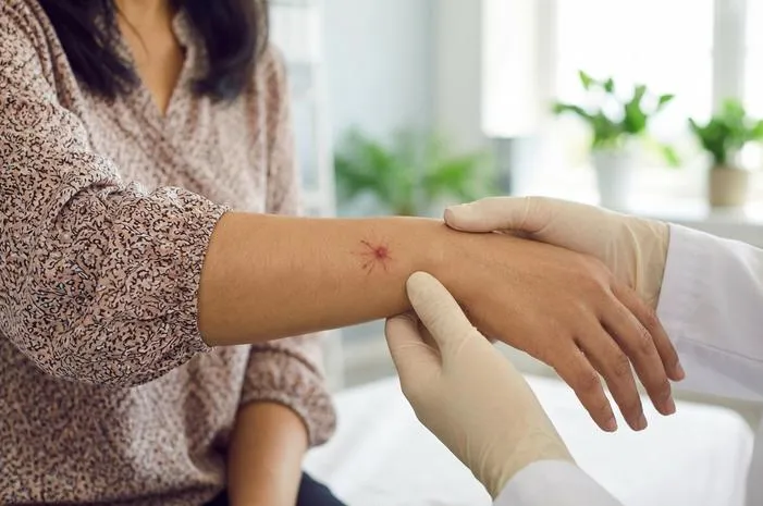 Spider Nevi: Bintik Laba-laba, Kenali dan Atasi