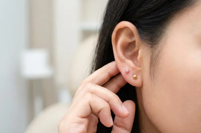 Pahami Benjolan di Telinga Dekat Anting, Mudah Diatasi