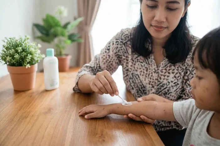 Basmi Kudis Secara Permanen? Ini Cara Anti Kambuhnya