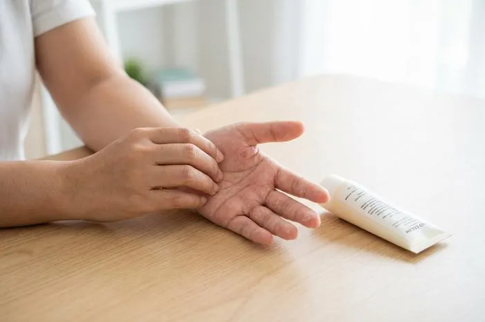 Waspada, Ini Bentuk Kutu Air di Tangan yang Sering Muncul