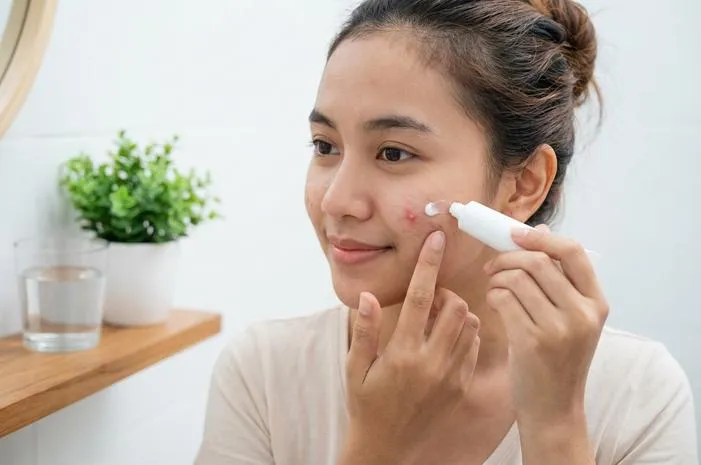 Cara Mengatasi Jerawat Meradang: Kulit Mulus Kembali!
