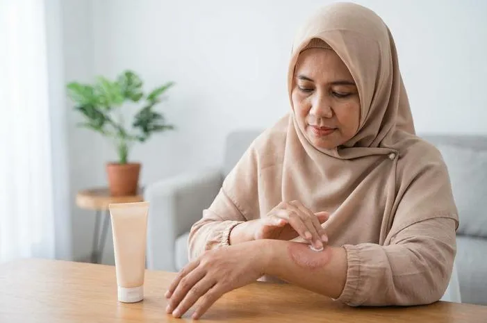 Nummular Dermatitis: Pahami Eksim Koin dan Redakan Gatalnya