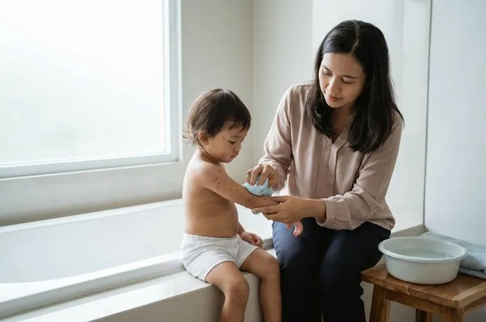 Apakah Cacar Air Boleh Mandi Air Dingin? Simak Aturannya