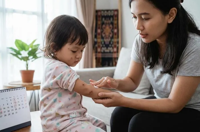 Berapa Hari Cacar Air Sembuh? 7-14 Hari Tuntas