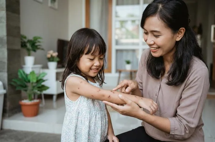 Ciri Cacar Air Sudah Tidak Menular, Bebas Main Lagi!