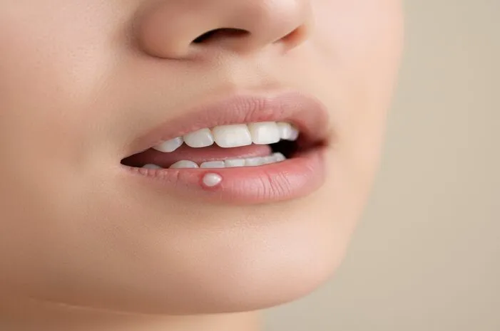 Lihat Gambar Sariawan di Gusi: Pahami Gejala dan Obatinya