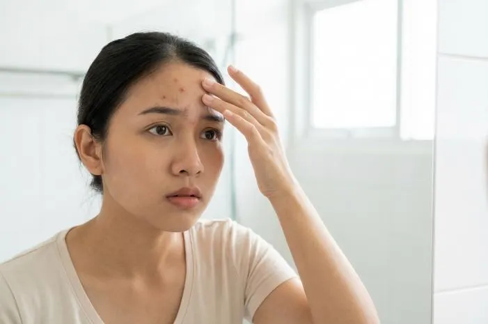 Jerawat di Jidat Kenapa Muncul Ini Penyebab dan Solusinya