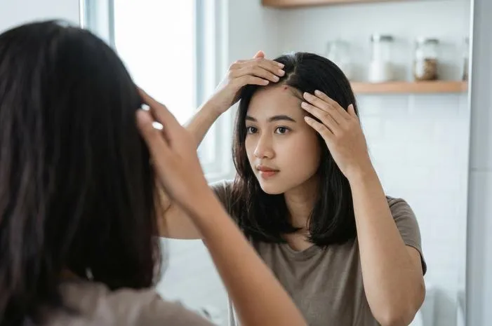 Jerawat Kepala Ganggu? Ini Cara Ampuh Mengatasinya