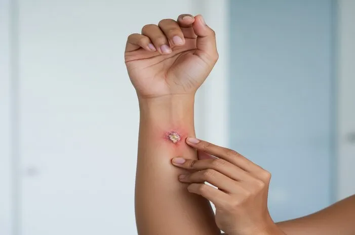 Kenali Ciri Luka Infeksi Agar Cepat Diobati