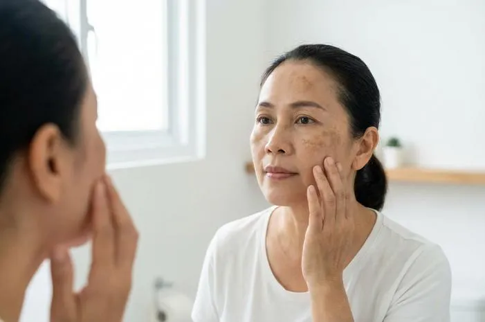 Pudarkan Melasma Wajah: Rahasia Kulit Bebas Flek Hitam