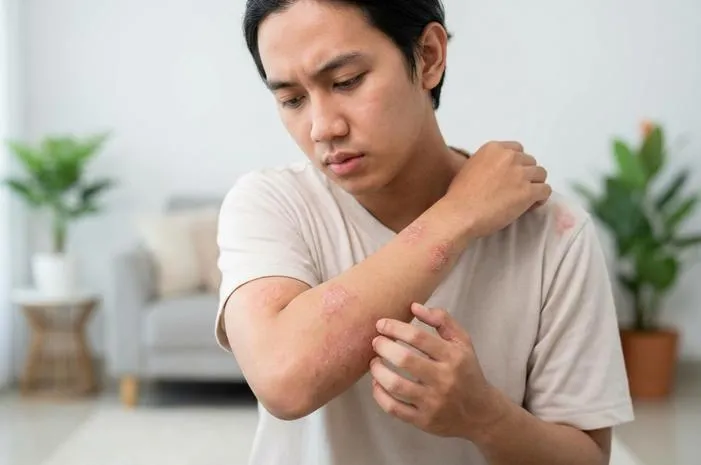 Gatal Panu Merah Mengganggu? Cek Cara Ampuh Ini