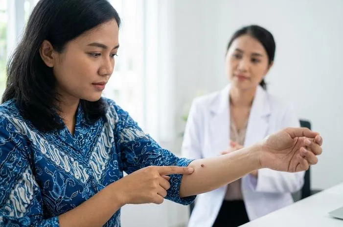 Papilloma: Jinak Tapi Waspada Risiko Kanker HPV