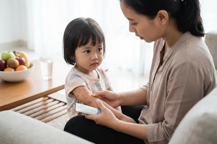 Tips Ampuh Mengatasi Biduran pada Anak 2 Tahun di Rumah