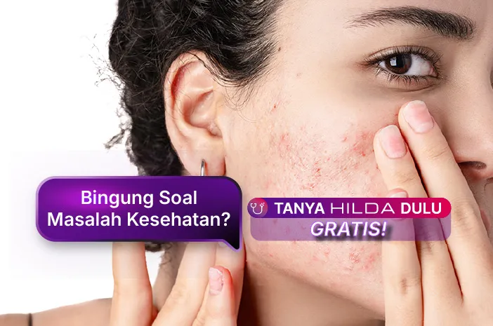 8 Cara Menghilangkan Bruntusan di Jidat yang Bikin Minder