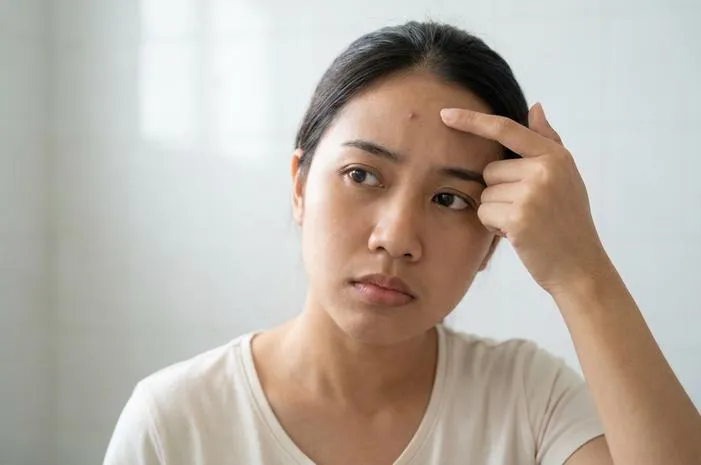 Jerawat di Dahi Karena Apa? Ini Penyebabnya!