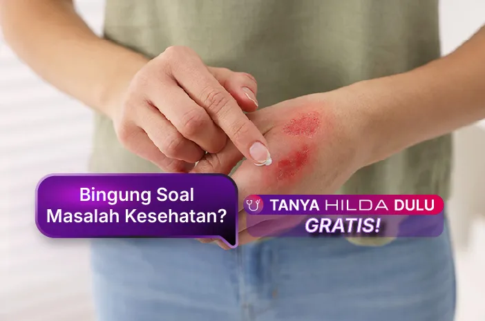 Luka Bakar Melepuh: Ini Cara Cepat Menanganinya