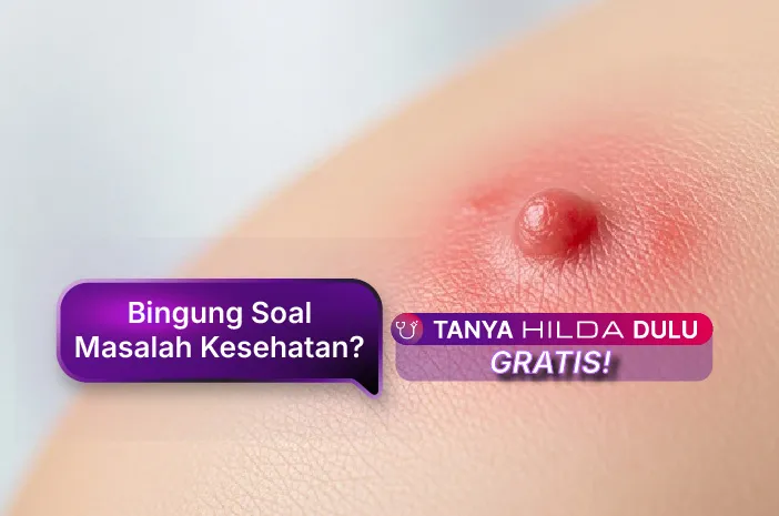 Bisul Tak Kunjung Kempes? Ini Cara Mengobatinya dengan Tepat