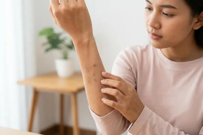 Tips Menghilangkan Bekas Campak Menghitam Agar Kulit Mulus