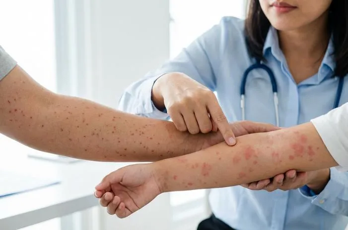 Kenali Perbedaan Bintik DBD dan Campak Agar Tidak Keliru