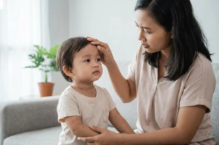 Kenali Gejala Campak pada Balita dan Cara Mengatasinya