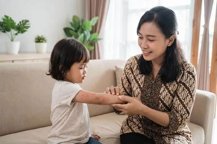 Berapa Lama Ruam Campak Hilang dan Tahapan Penyembuhannya