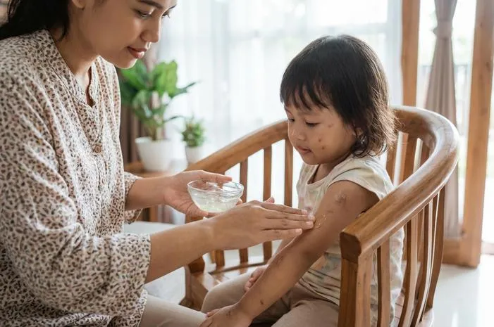 Cara Alami Menghilangkan Bekas Campak pada Anak yang Ampuh