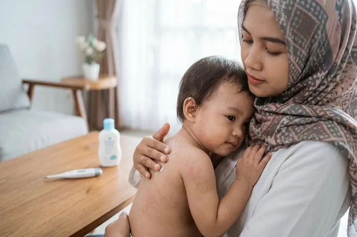 Demam Ruam Anak: Ini Exanthema Subitum Si Penyakit Keenam