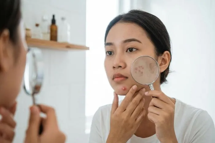 Ini Rekomendasi Obat Jerawat Meradang Paling Ampuh