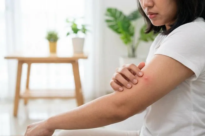 Ciri-Ciri Digigit Nyamuk DBD: Bukan Bentol Biasa