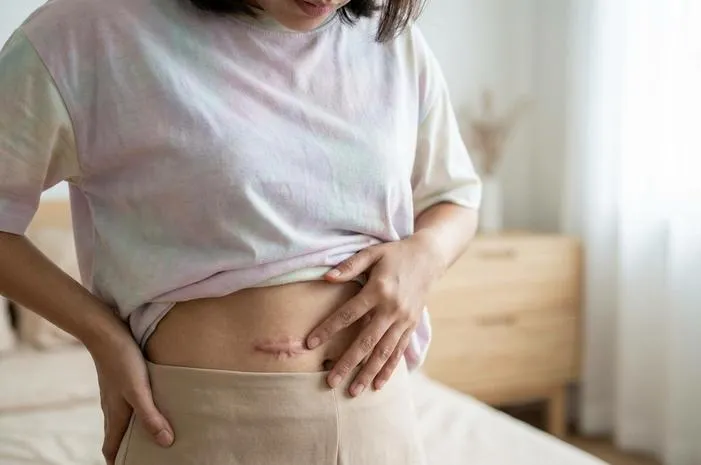 Bekas SC Keloid Membandel? Ini Solusi Terbaiknya