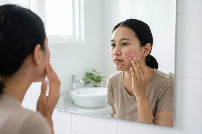 Kenali Perbedaan PIH dan PIE Bekas Jerawat Merah Hitam